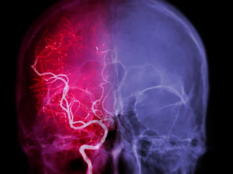 A lakóhely befolyásolja a stroke kockázatát