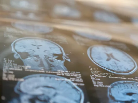 Védheti az agyat stroke esetén
