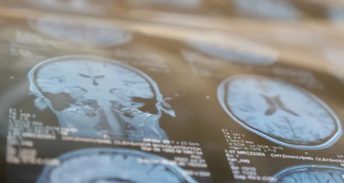 Védheti az agyat stroke esetén
